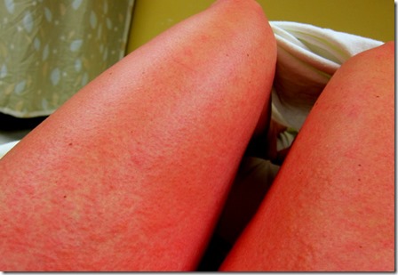 allergic reaction legs