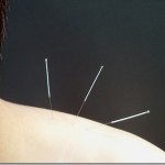 acupuncture acupuncture