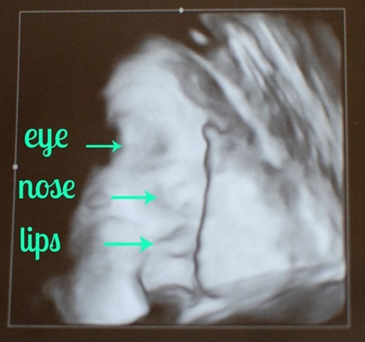 34 week ultrasound